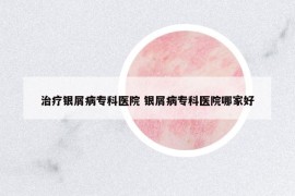治療銀屑病?？漆t(yī)院 銀屑病?？漆t(yī)院哪家好