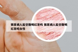 銀屑病人能空腹喝紅茶嗎 銀屑病人能空腹喝紅茶嗎女性