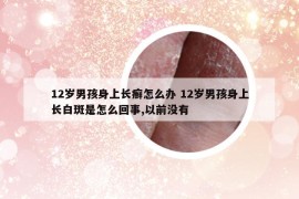 12歲男孩身上長(zhǎng)癬怎么辦 12歲男孩身上長(zhǎng)白斑是怎么回事,以前沒(méi)有