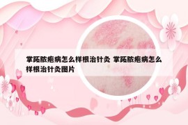 掌跖膿皰病怎么樣根治針灸 掌跖膿皰病怎么樣根治針灸圖片