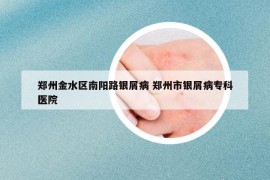 鄭州金水區(qū)南陽路銀屑病 鄭州市銀屑病?？漆t(yī)院