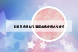 副銀屑病曬太陽 銀屑病患者曬太陽好嗎