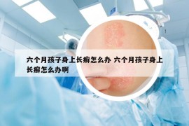 六個(gè)月孩子身上長(zhǎng)癬怎么辦 六個(gè)月孩子身上長(zhǎng)癬怎么辦啊