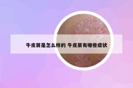 牛皮屑是怎么樣的 牛皮屑有哪些癥狀