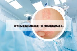 掌趾膿皰病會傳染嗎 掌趾膿胞病傳染嗎