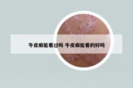 牛皮癬能看過(guò)嗎 牛皮癬能看的好嗎