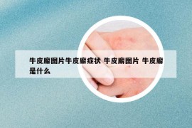 牛皮廨圖片牛皮廨癥狀 牛皮廨圖片 牛皮廨是什么