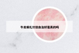 牛皮癬扎針放血治好是真的嗎