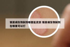 銀屑病生物制劑哪里能賣(mài)到 銀屑病生物制劑在哪里可以打