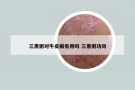 三黑粥對(duì)牛皮癬有用嗎 三黑粥功效