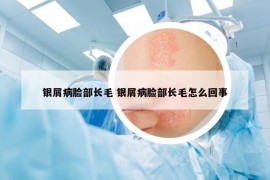 銀屑病臉部長(zhǎng)毛 銀屑病臉部長(zhǎng)毛怎么回事