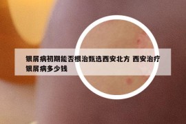銀屑病初期能否根治甄選西安北方 西安治療銀屑病多少錢(qián)