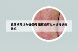 銀屑病可以辦低保嗎 銀屑病可以申請(qǐng)慢病救助嗎