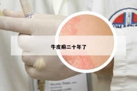牛皮癬二十年了