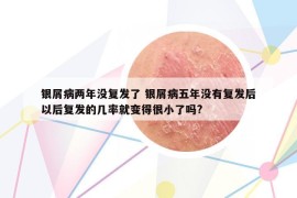 銀屑病兩年沒復(fù)發(fā)了 銀屑病五年沒有復(fù)發(fā)后以后復(fù)發(fā)的幾率就變得很小了嗎?