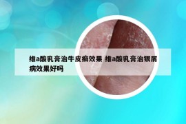 維a酸乳膏治牛皮癬效果 維a酸乳膏治銀屑病效果好嗎