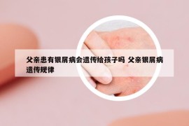 父親患有銀屑病會(huì)遺傳給孩子嗎 父親銀屑病遺傳規(guī)律