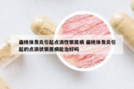 扁桃體發(fā)炎引起點(diǎn)滴性銀屑病 扁桃體發(fā)炎引起的點(diǎn)滴狀銀屑病能治好嗎