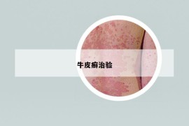 牛皮癬治驗