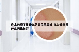 身上長(zhǎng)癬了用什么藥膏效果最好 身上長(zhǎng)癬用什么藥比較好