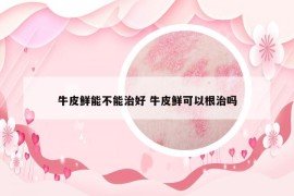 牛皮鮮能不能治好 牛皮鮮可以根治嗎