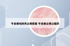 牛皮癬吃防風(fēng)止癢膠囊 牛皮癬止癢口服藥