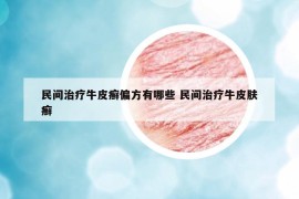 民間治療牛皮癬偏方有哪些 民間治療牛皮膚癬