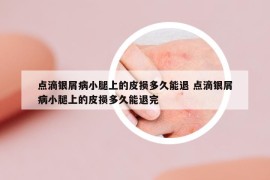 點滴銀屑病小腿上的皮損多久能退 點滴銀屑病小腿上的皮損多久能退完