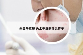 頭里牛皮癬 頭上牛皮癬什么樣子