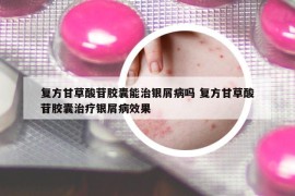 復(fù)方甘草酸苷膠囊能治銀屑病嗎 復(fù)方甘草酸苷膠囊治療銀屑病效果