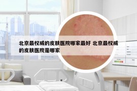 北京最權威的皮膚醫(yī)院哪家最好 北京最權威的皮膚醫(yī)院是哪家