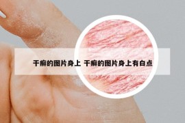 干癬的圖片身上 干癬的圖片身上有白點(diǎn)