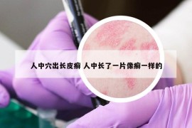 人中穴出長皮癬 人中長了一片像癬一樣的