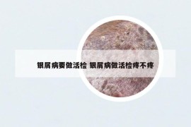 銀屑病要做活檢 銀屑病做活檢疼不疼