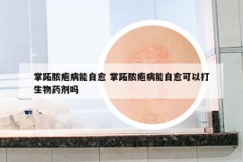 掌跖膿皰病能自愈 掌跖膿皰病能自愈可以打生物藥劑嗎