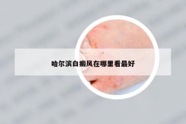 哈爾濱白癜風(fēng)在哪里看最好