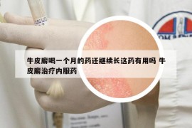 牛皮廨喝一個(gè)月的藥還繼續(xù)長這藥有用嗎 牛皮廨治療內(nèi)服藥