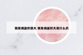 銀屑病面積很大 銀屑病面積大用什么藥