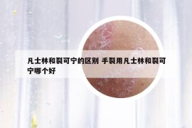 凡士林和裂可寧的區(qū)別 手裂用凡士林和裂可寧哪個(gè)好