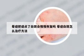 暈痣把痣點(diǎn)了白斑會慢慢恢復(fù)嗎 暈痣白斑怎么治療方法