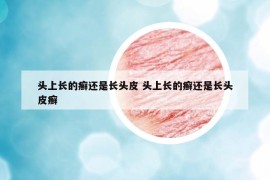 頭上長的癬還是長頭皮 頭上長的癬還是長頭皮癬