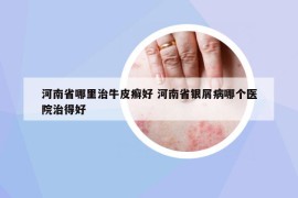 河南省哪里治牛皮癬好 河南省銀屑病哪個(gè)醫(yī)院治得好