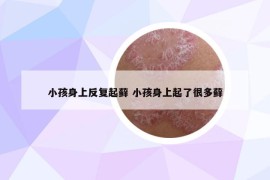 小孩身上反復(fù)起蘚 小孩身上起了很多蘚