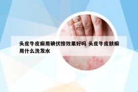 頭皮牛皮癬用碘伏擦效果好嗎 頭皮牛皮膚癬用什么洗發(fā)水