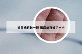 銀屑病只長一顆 銀屑病只長了一個