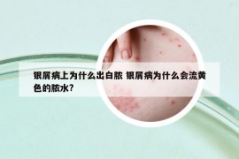 銀屑病上為什么出白膿 銀屑病為什么會流黃色的膿水?