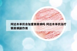 阿達(dá)木單抗會(huì)加重銀屑病嗎 阿達(dá)木單抗治療銀屑病副作用