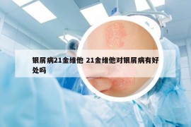 銀屑病21金維他 21金維他對銀屑病有好處嗎
