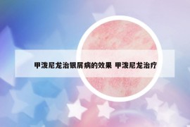 甲潑尼龍治銀屑病的效果 甲潑尼龍治療