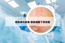 銀屑病與狐臭 銀屑病腋下癥狀圖